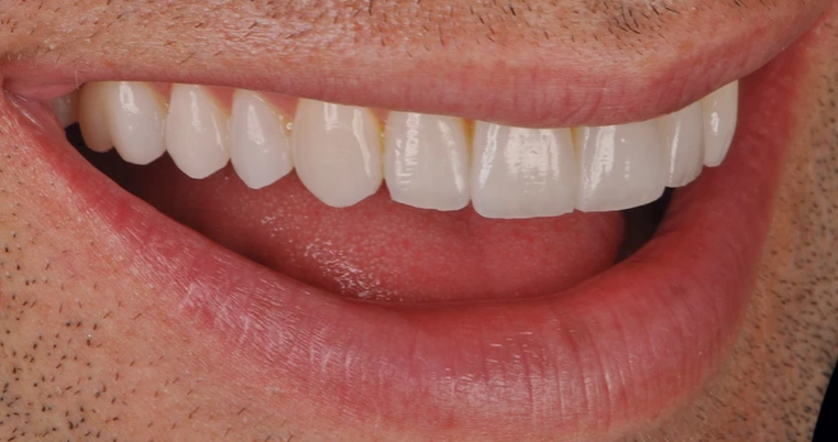 Caso clínico 10 - Después